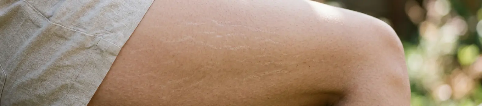 Peeling Estrías
